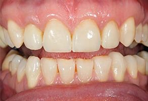 The image shows a close-up view of a person s teeth with visible signs of dental decay, including discoloration and cavities, with a focus on a front tooth that has been treated with a filling.