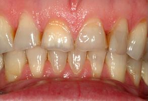 The image displays two photographs of a person s teeth with significant discoloration and staining, particularly noticeable on the lower front teeth.